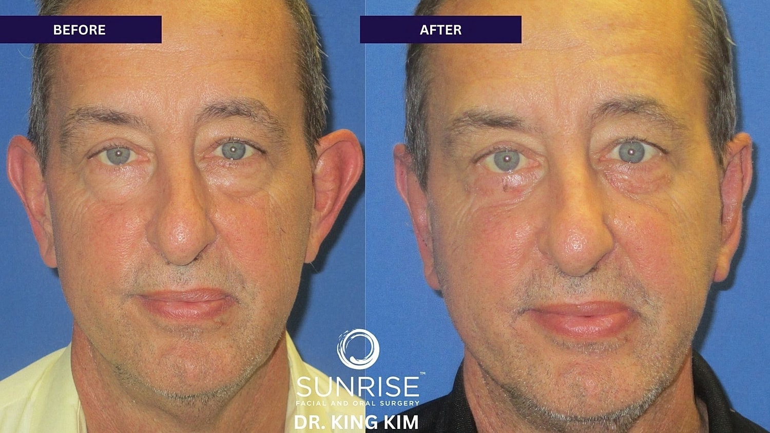 Otoplasty Before & After