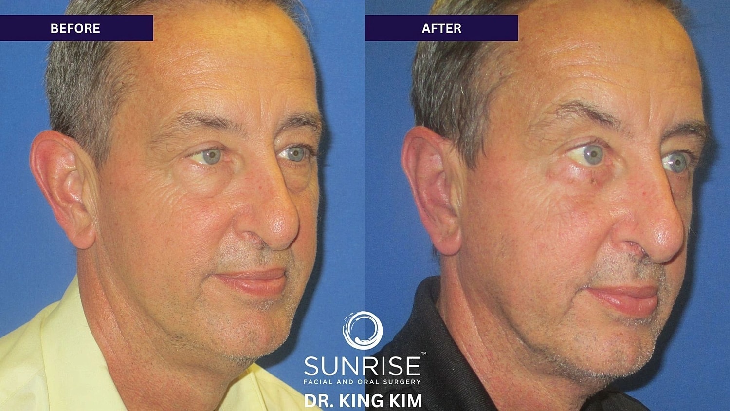 Otoplasty Before & After