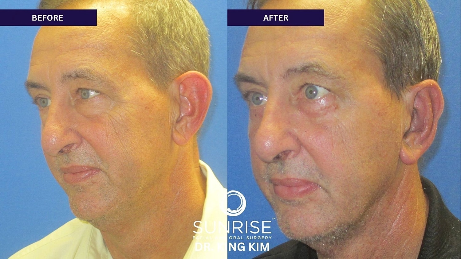 Otoplasty Before & After