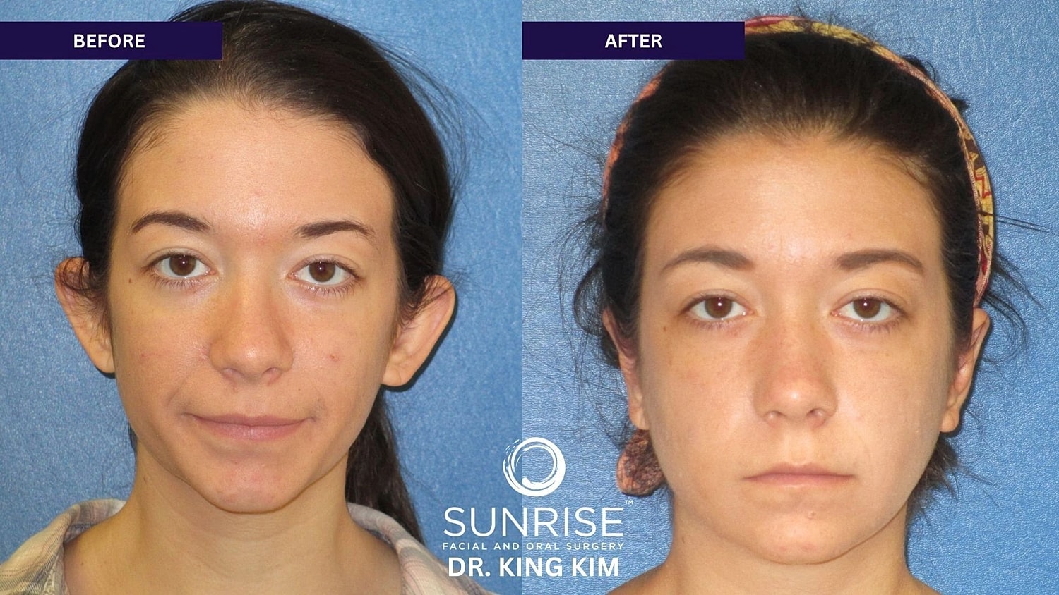 Otoplasty Before & After