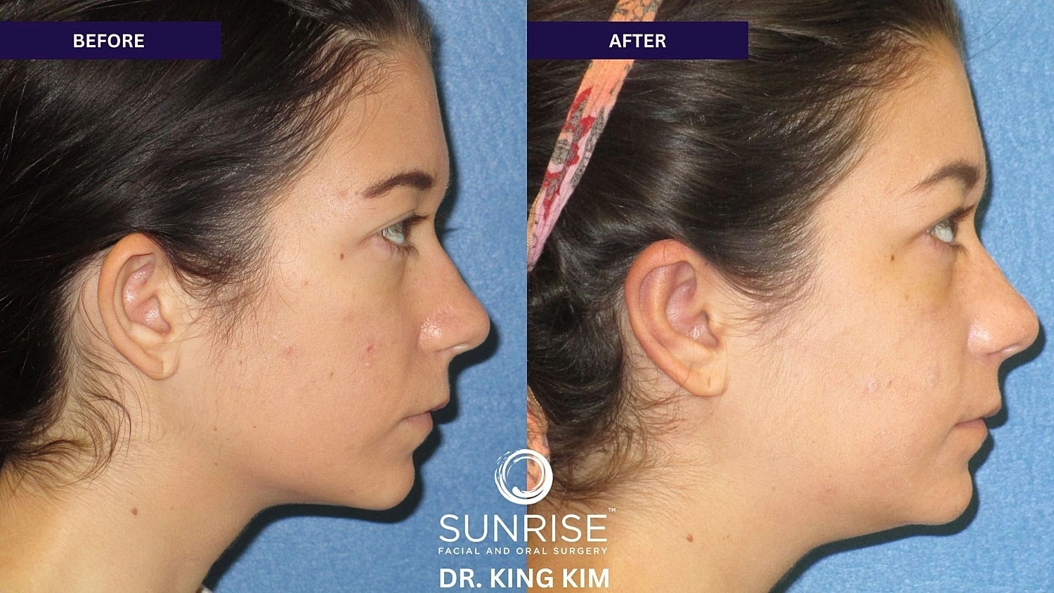 Otoplasty Before & After