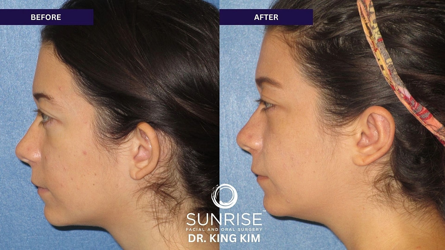 Otoplasty Before & After
