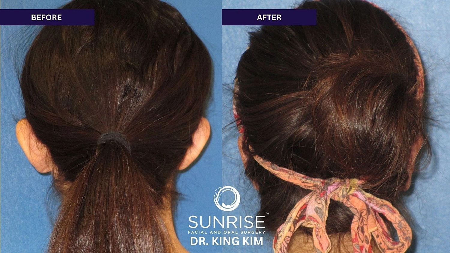 Otoplasty Before & After