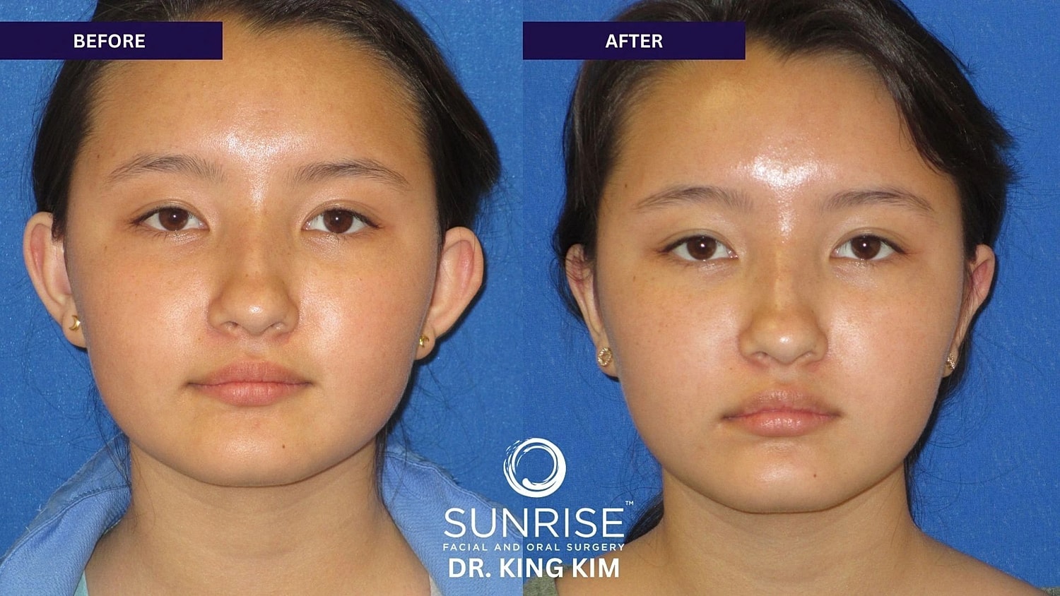 Otoplasty Before & After