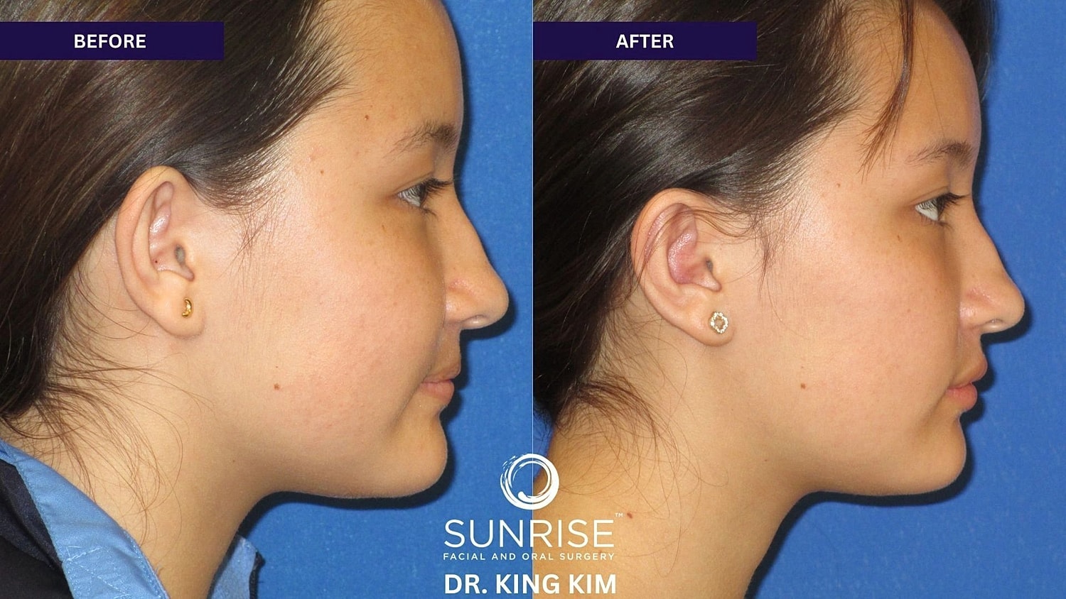 Otoplasty Before & After