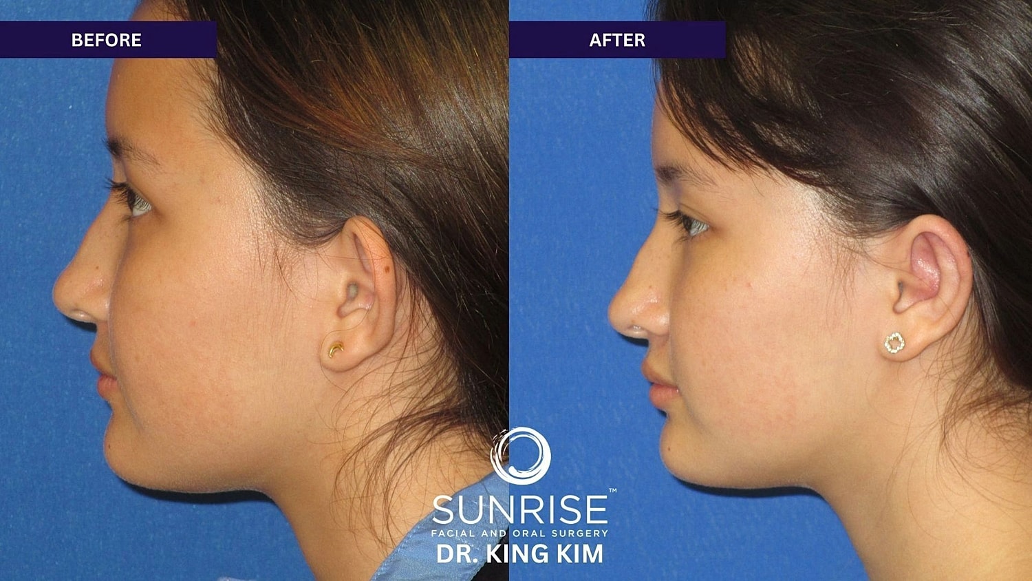 Otoplasty Before & After