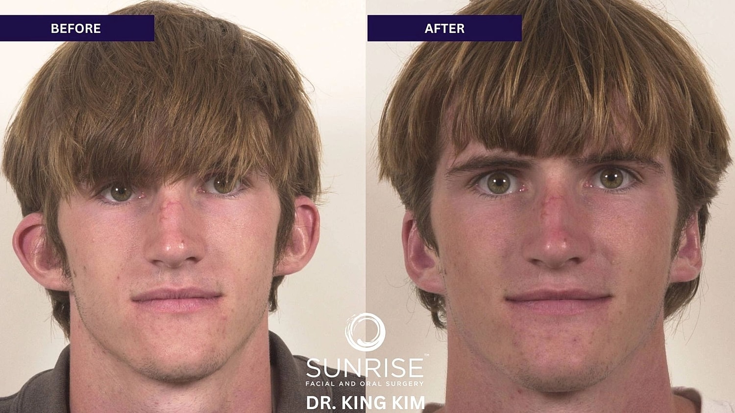 Otoplasty Before & After