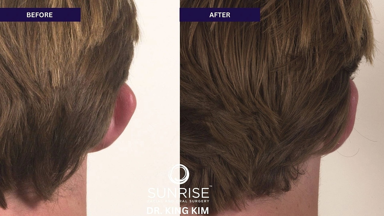 Otoplasty Before & After