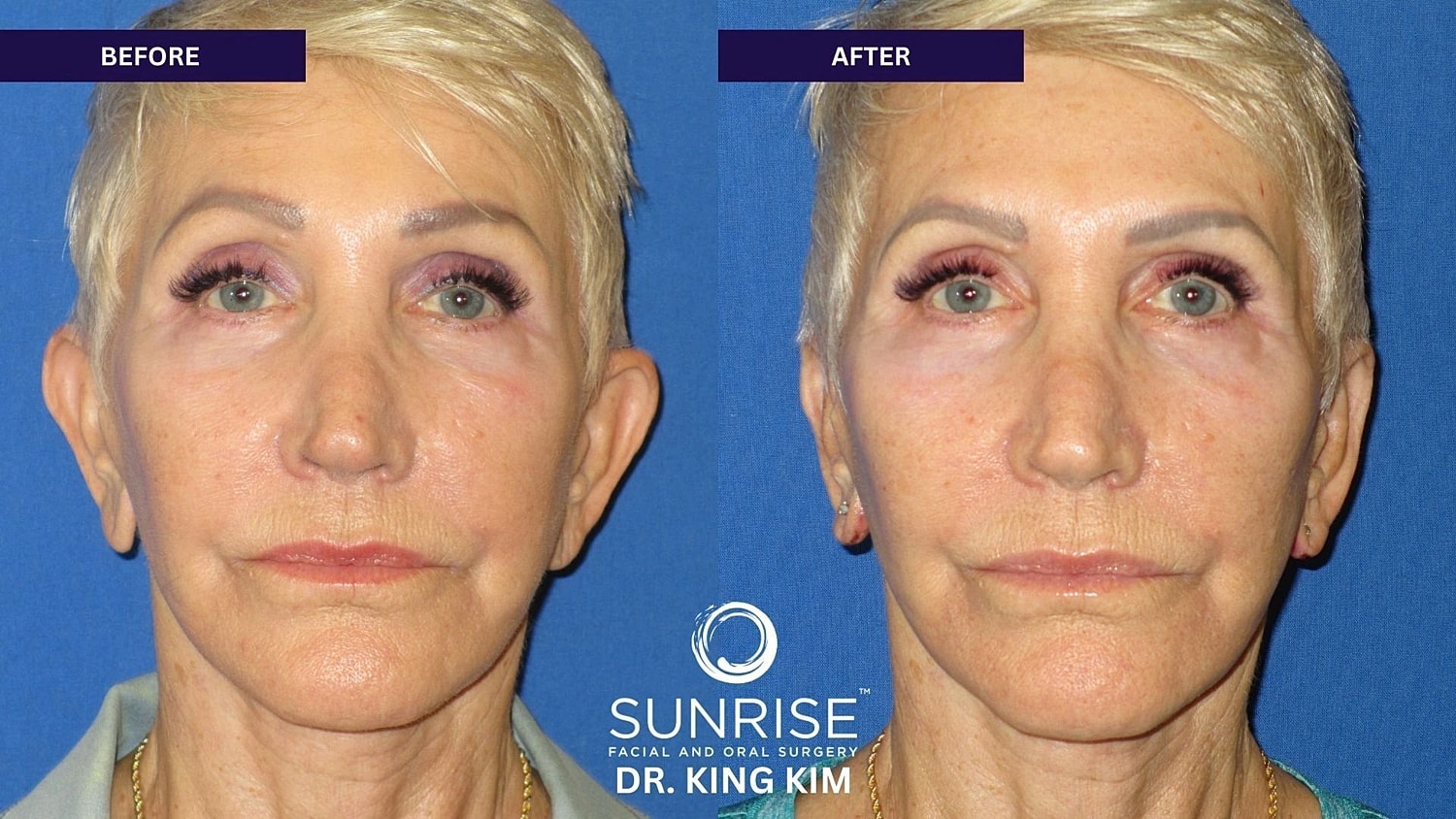 Otoplasty Before & After