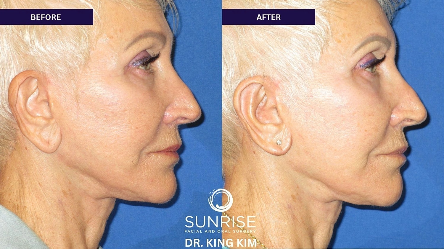 Otoplasty Before & After
