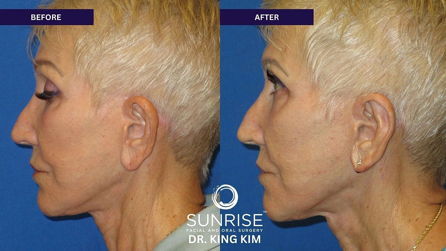 Otoplasty Before & After