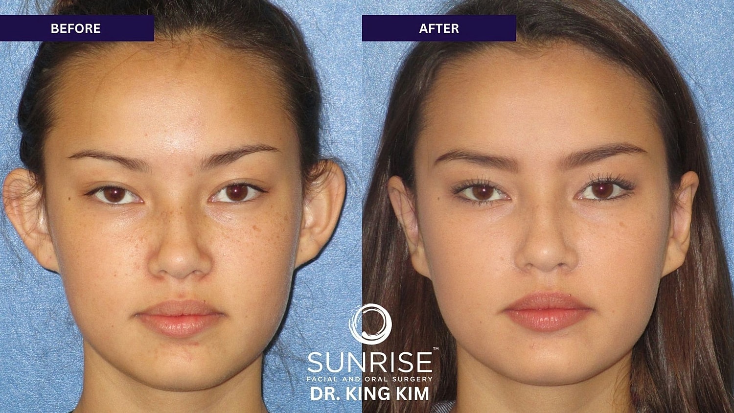 Otoplasty Before & After