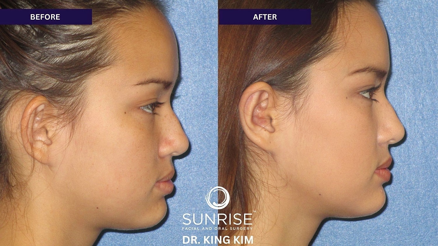 Otoplasty Before & After