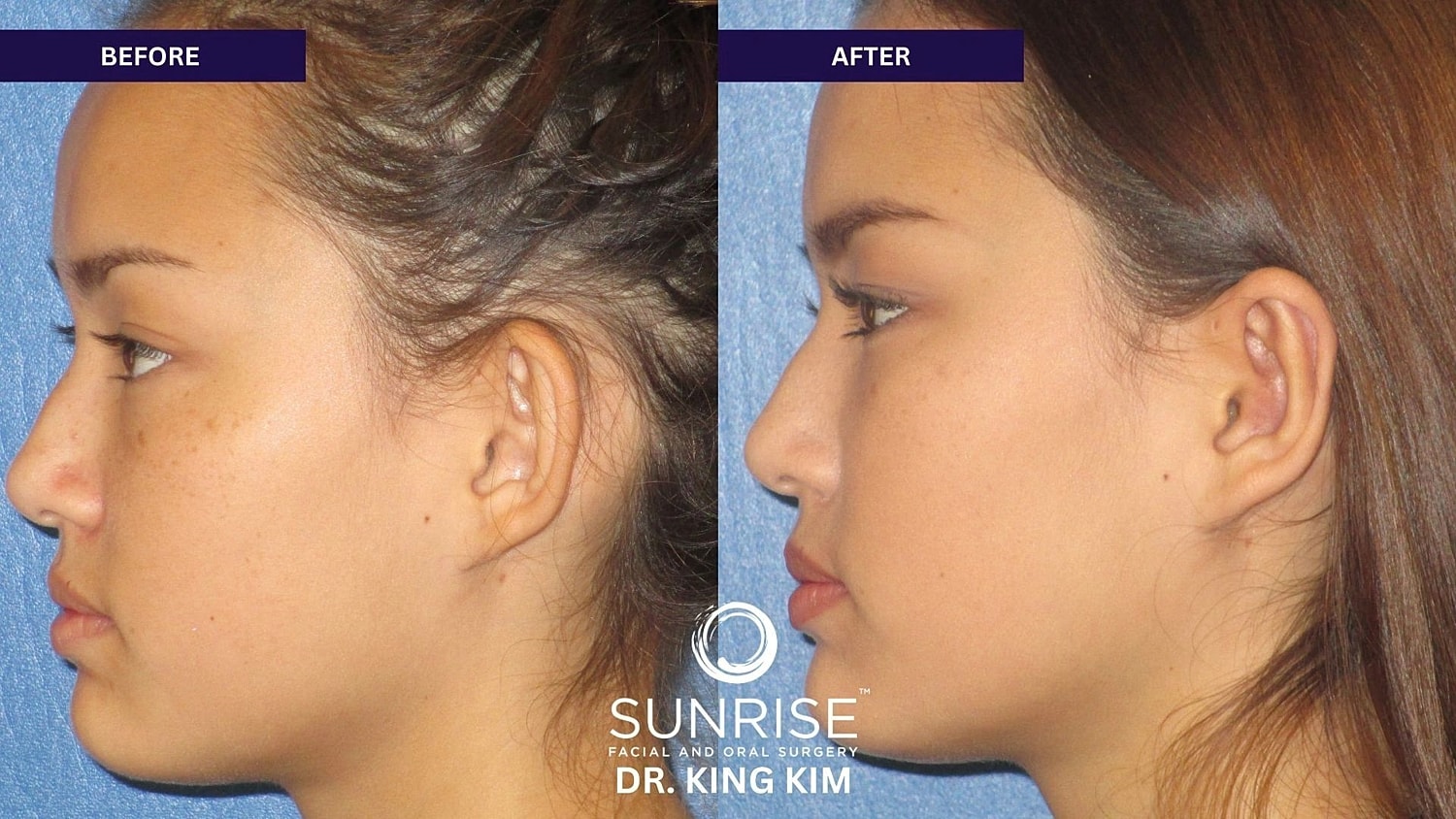 Otoplasty Before & After