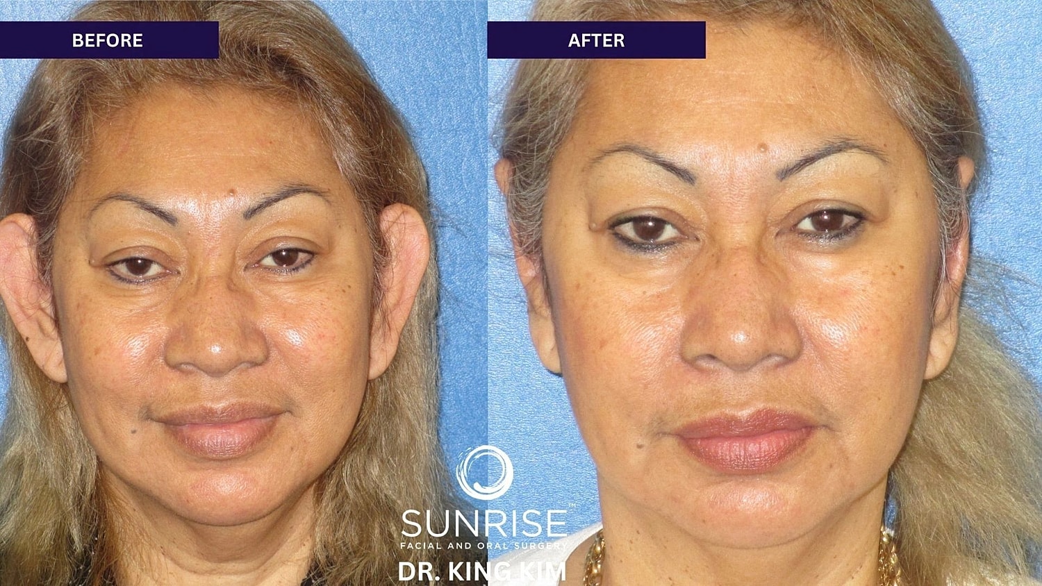 Otoplasty Before & After