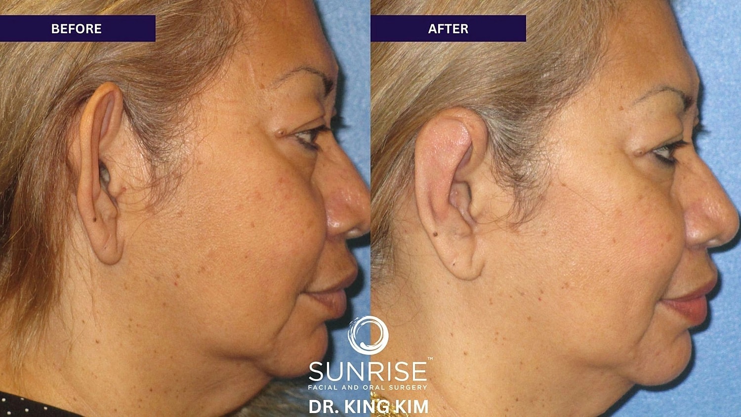Otoplasty Before & After