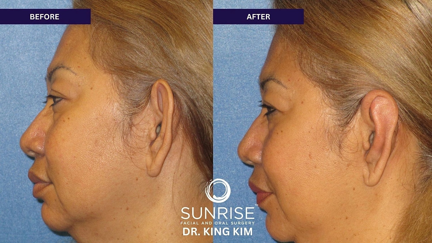 Otoplasty Before & After