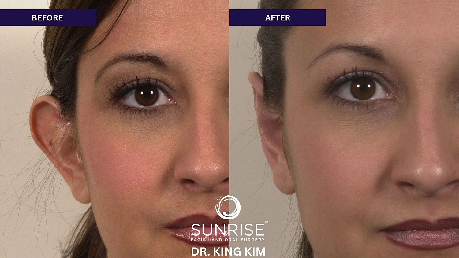 Otoplasty Before & After