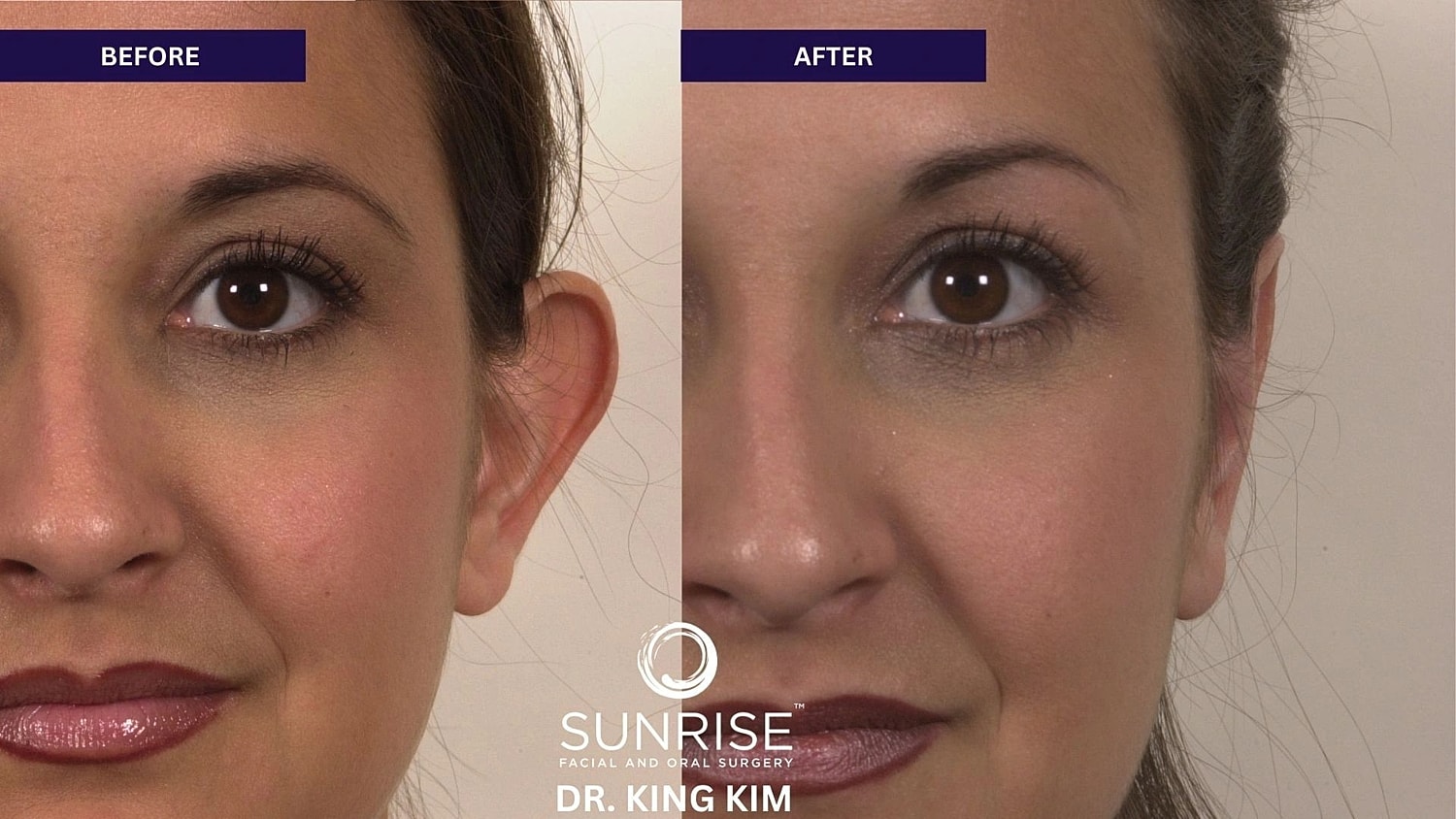 Otoplasty Before & After