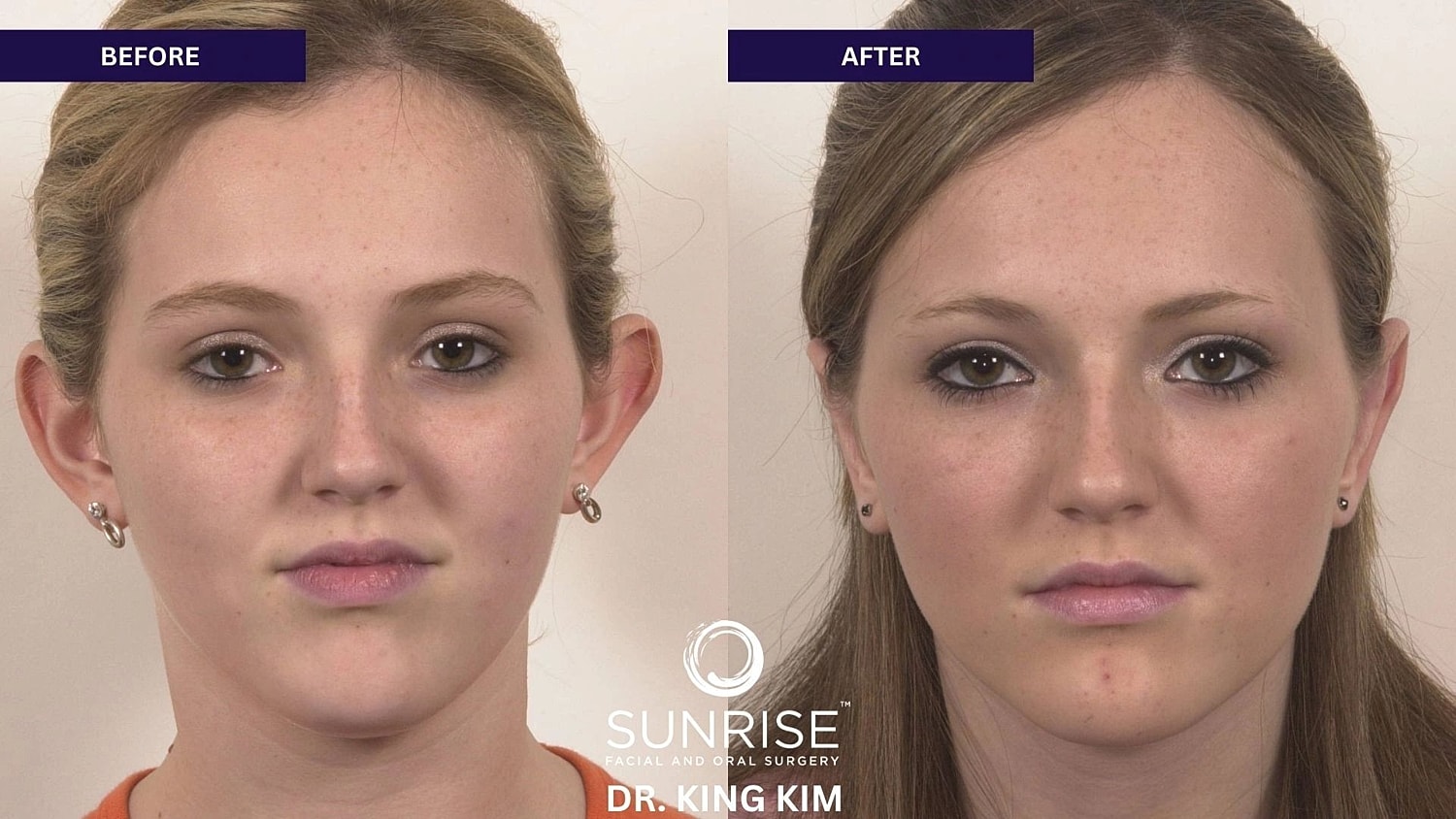 Otoplasty Before & After