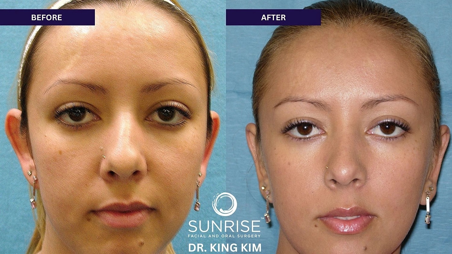 Otoplasty Before & After