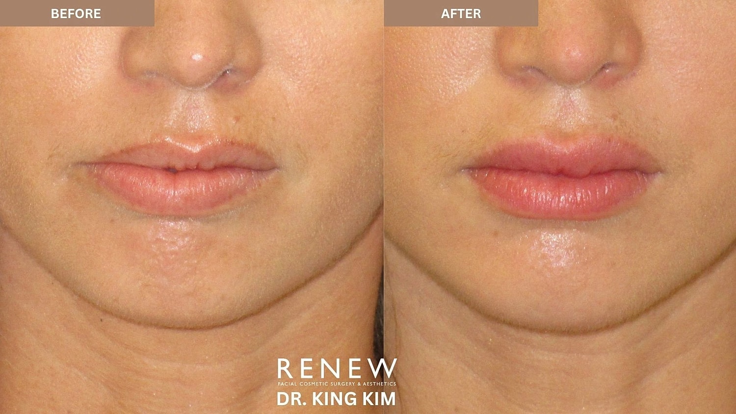 Lips Before & After