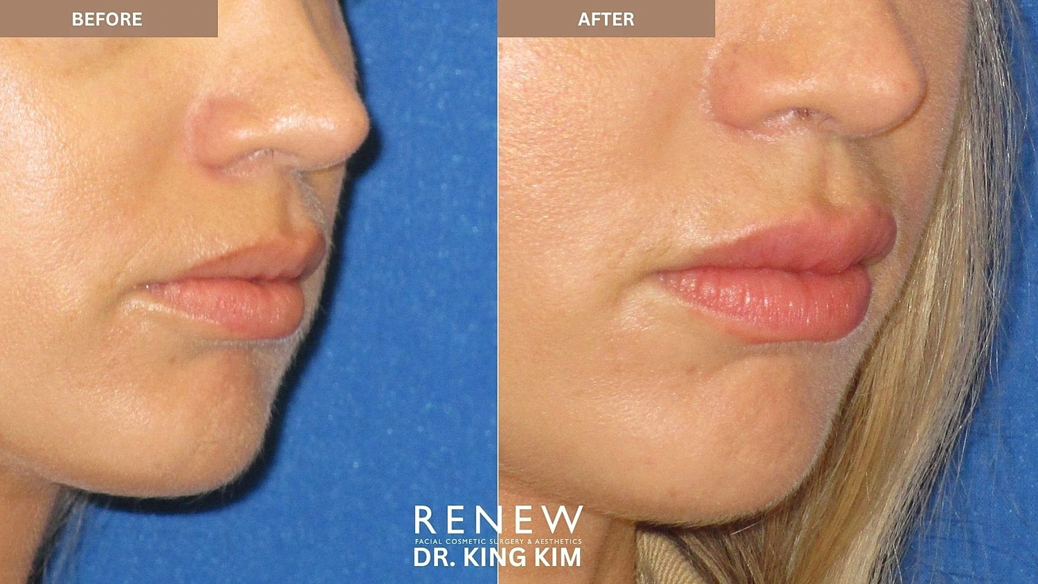 Lips Before & After
