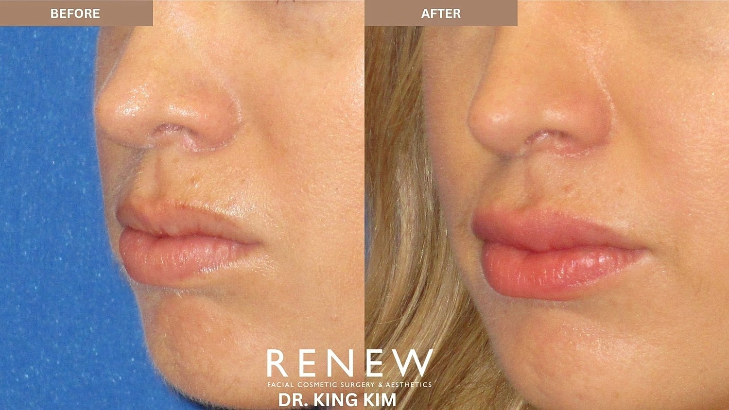 Lips Before & After