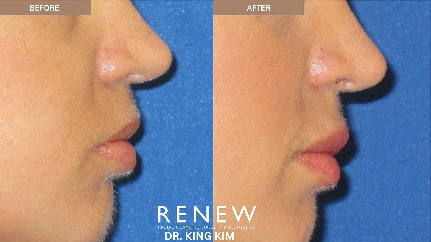Lips Before & After