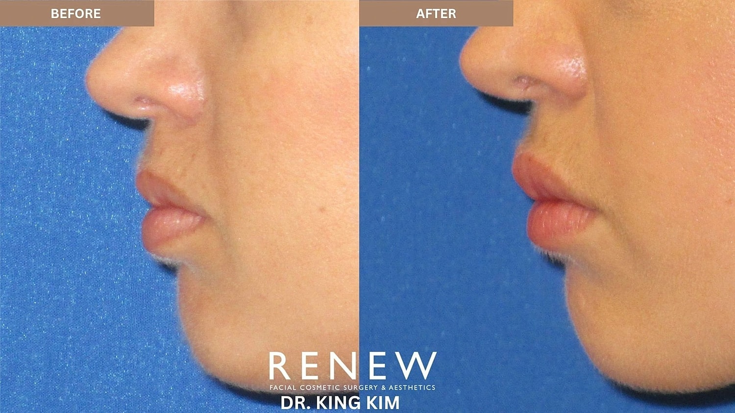 Lips Before & After