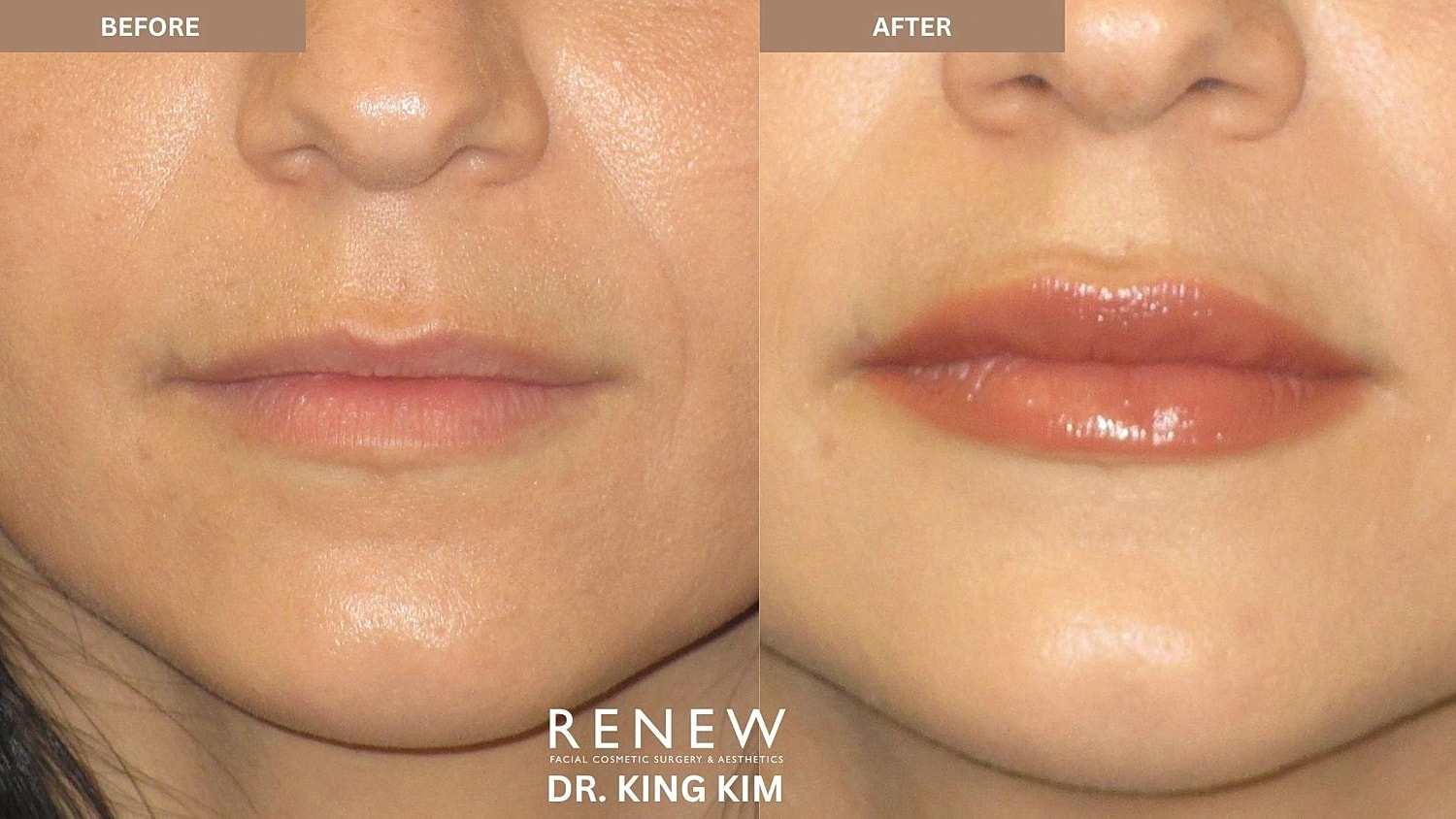 Lips Before & After