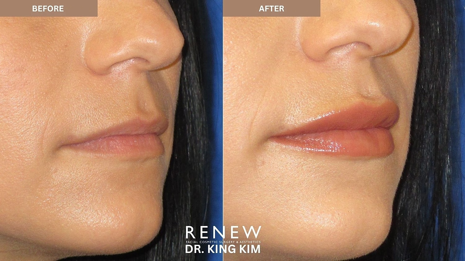 Lips Before & After