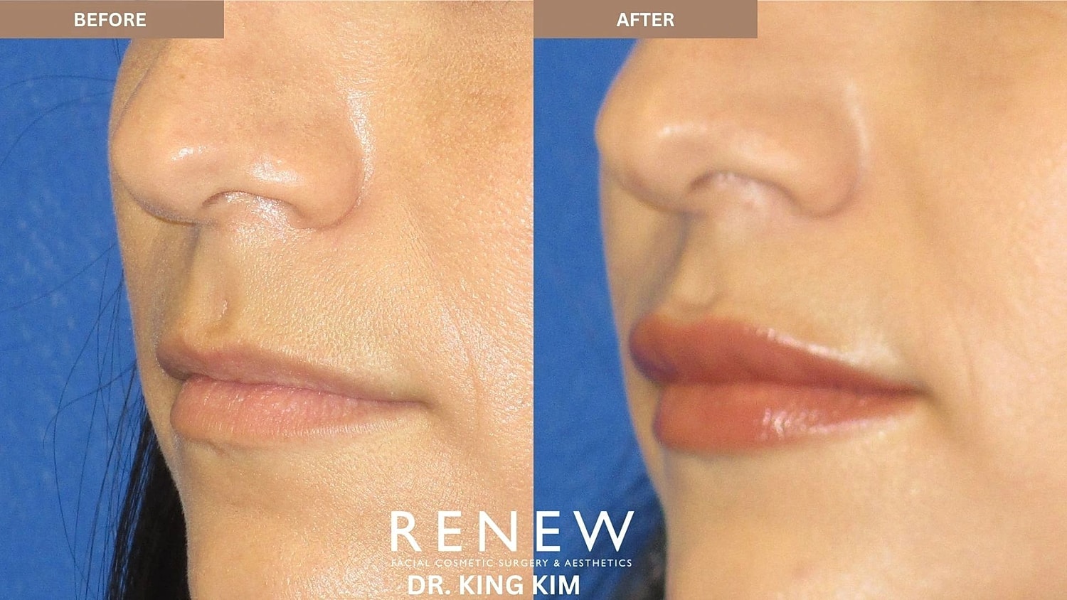 Lips Before & After