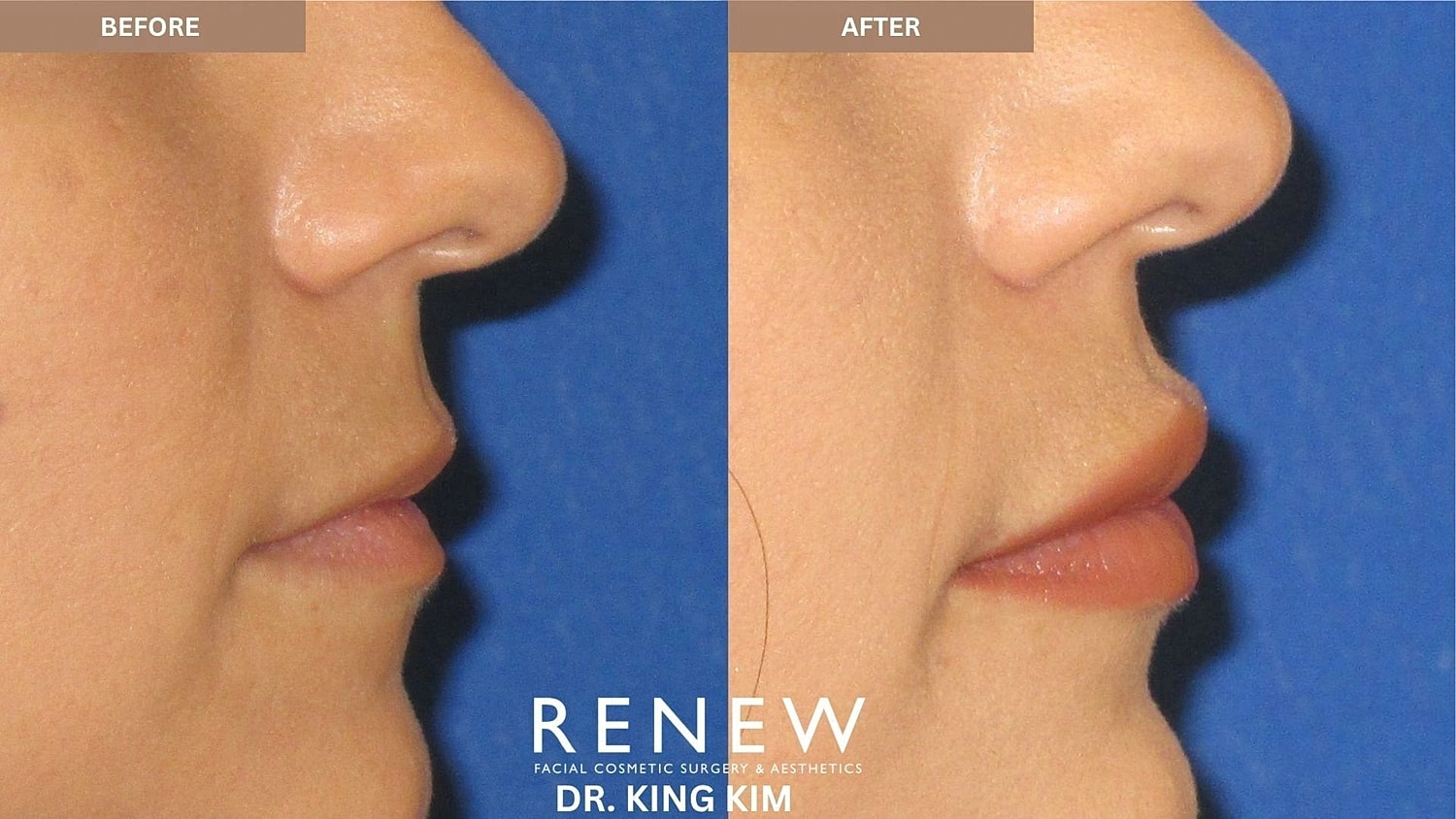 Lips Before & After