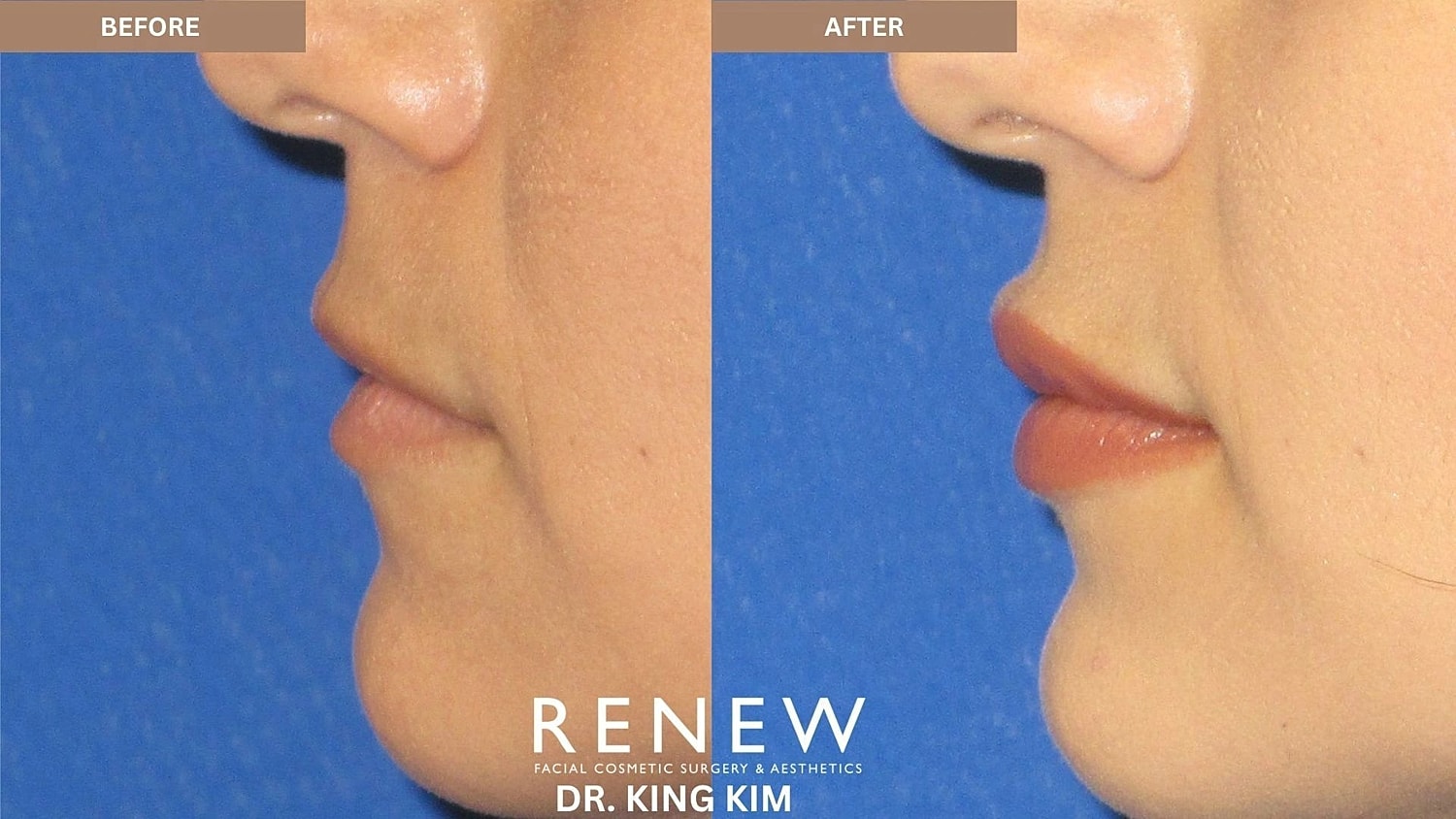 Lips Before & After