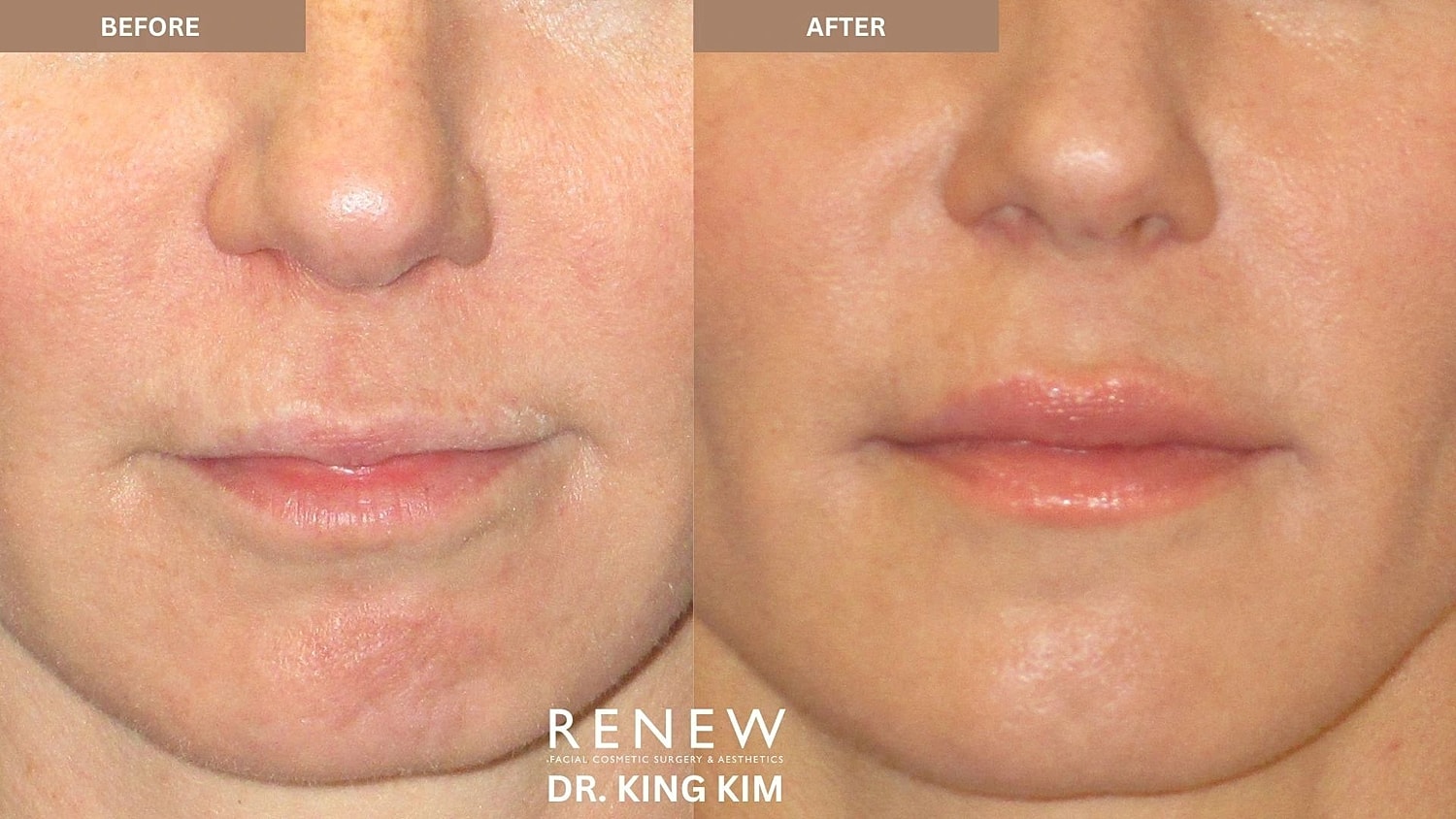 Lips Before & After
