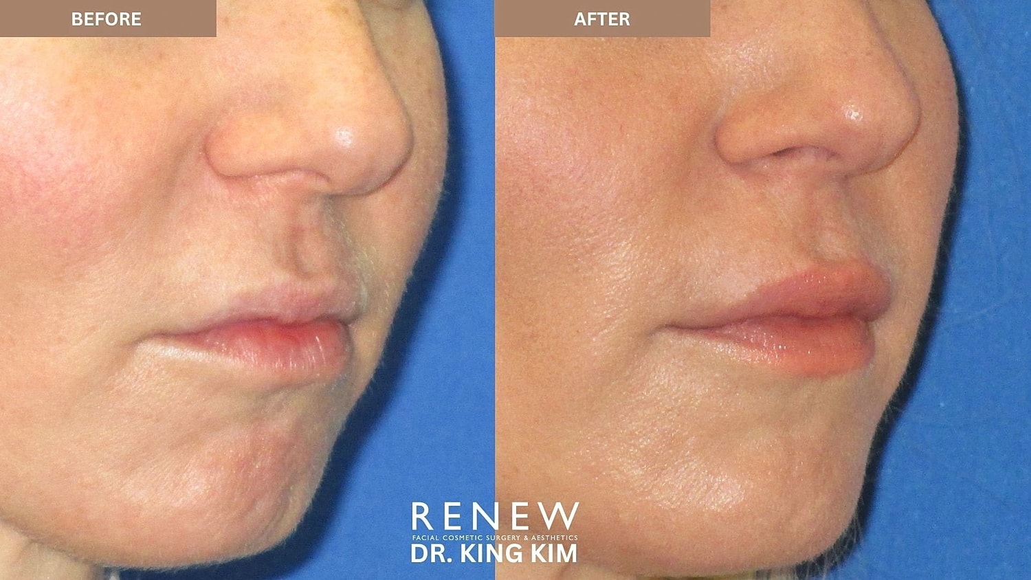 Lips Before & After