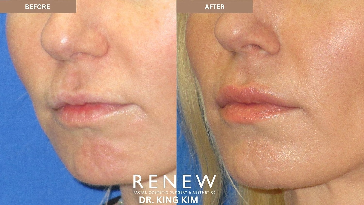 Lips Before & After