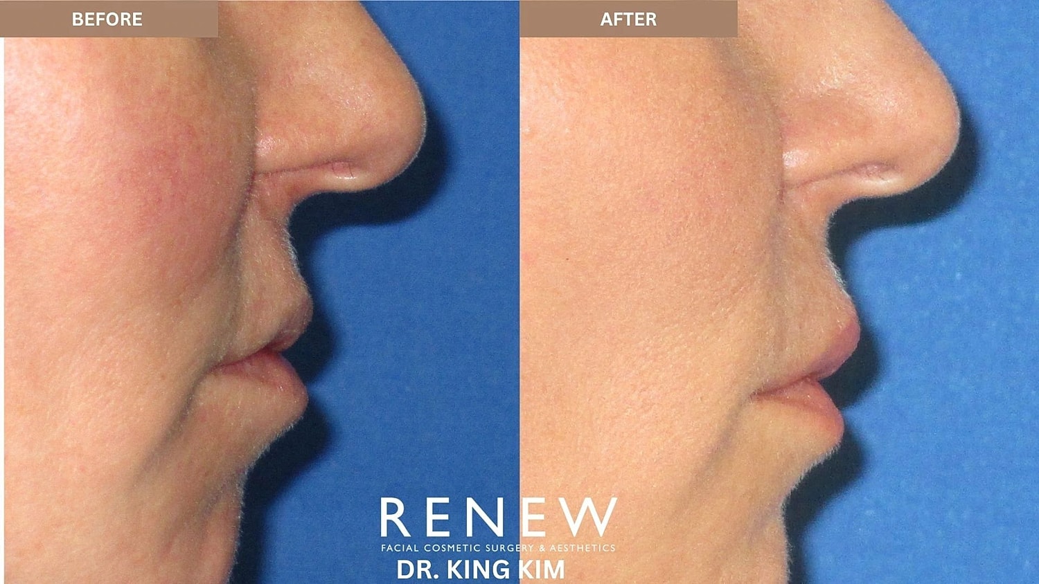 Lips Before & After