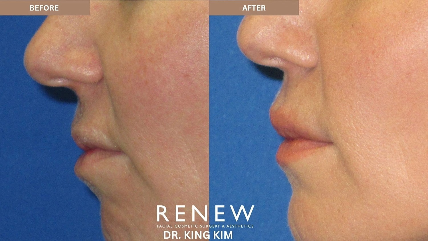 Lips Before & After