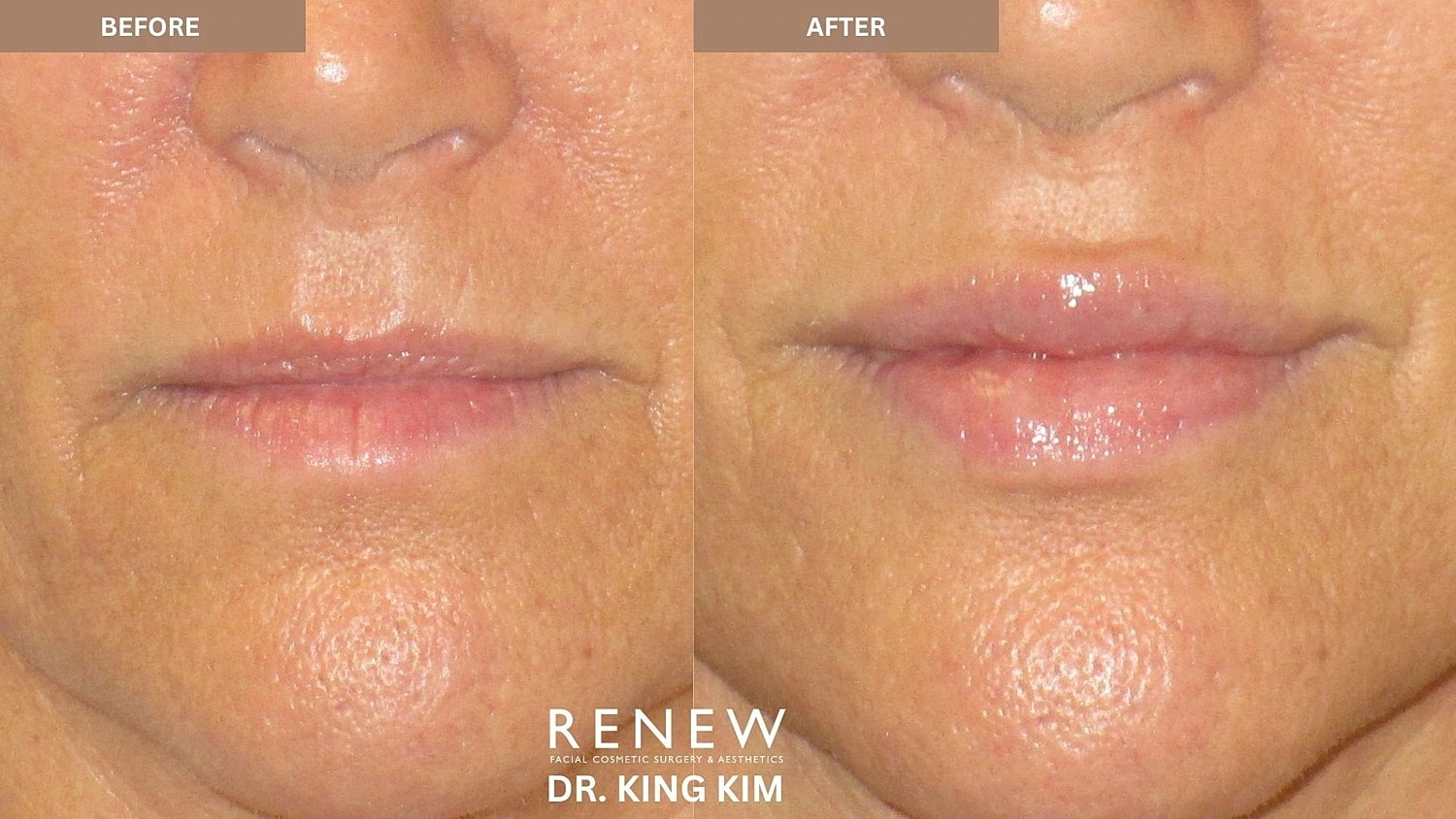 Lips Before & After