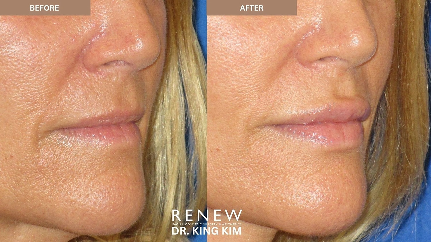 Lips Before & After
