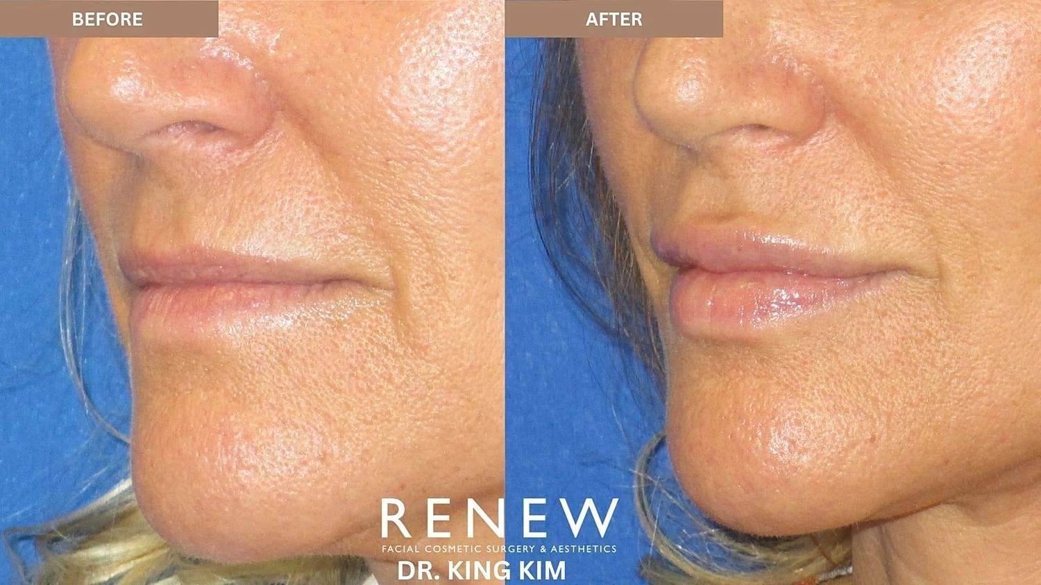 Lips Before & After