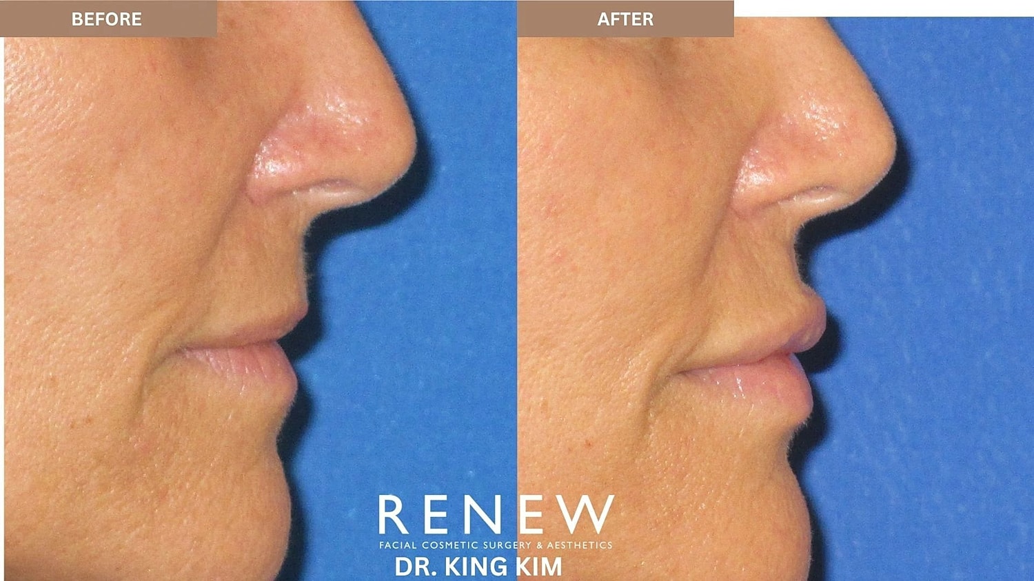 Lips Before & After