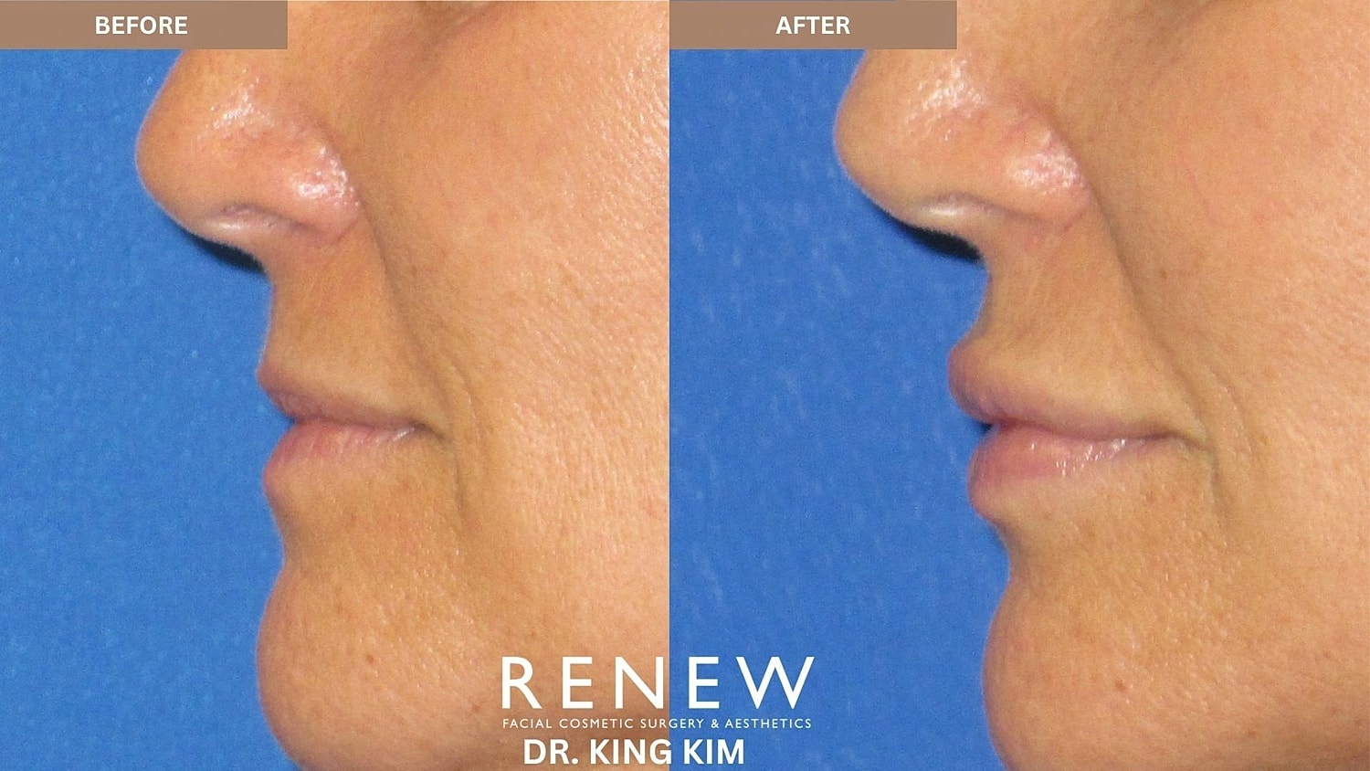 Lips Before & After