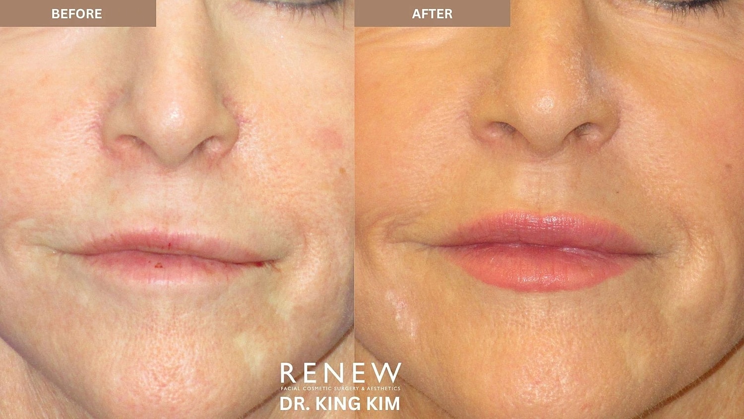 Lips Before & After
