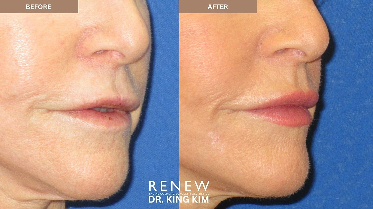 Lips Before & After