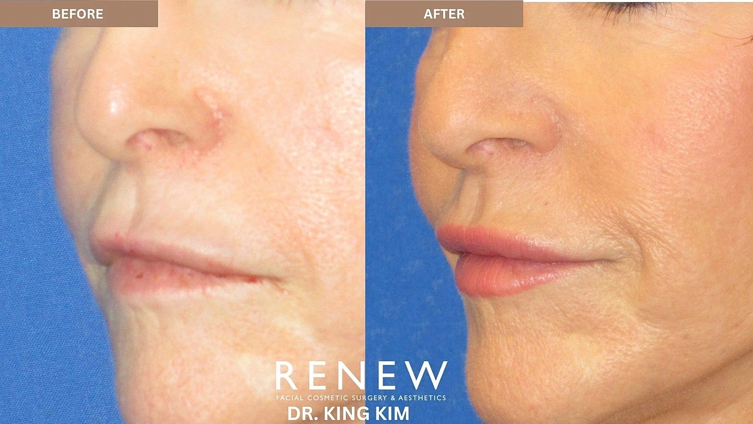 Lips Before & After