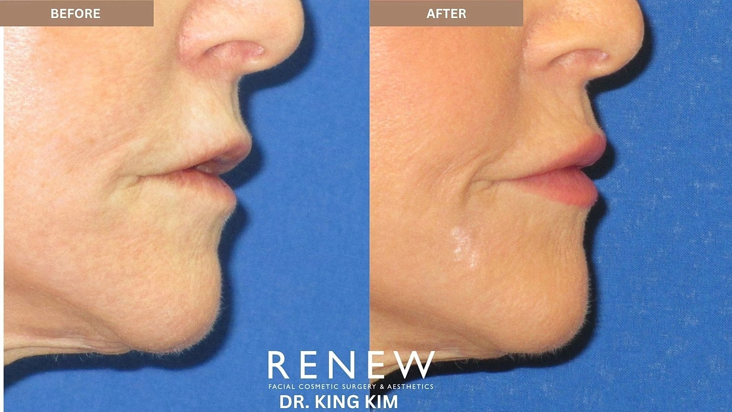 Lips Before & After