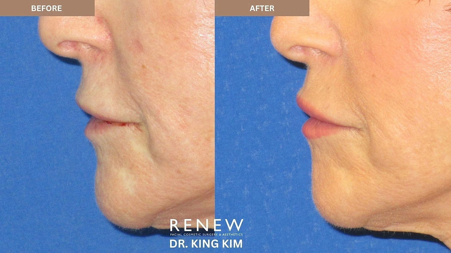 Lips Before & After